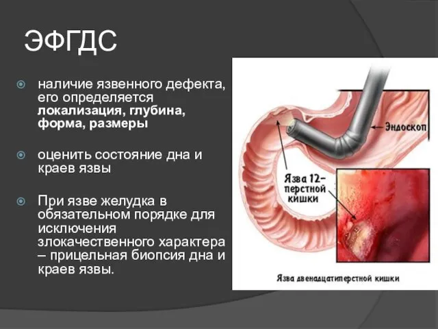 ЭФГДС наличие язвенного дефекта, его определяется локализация, глубина, форма, размеры оценить состояние