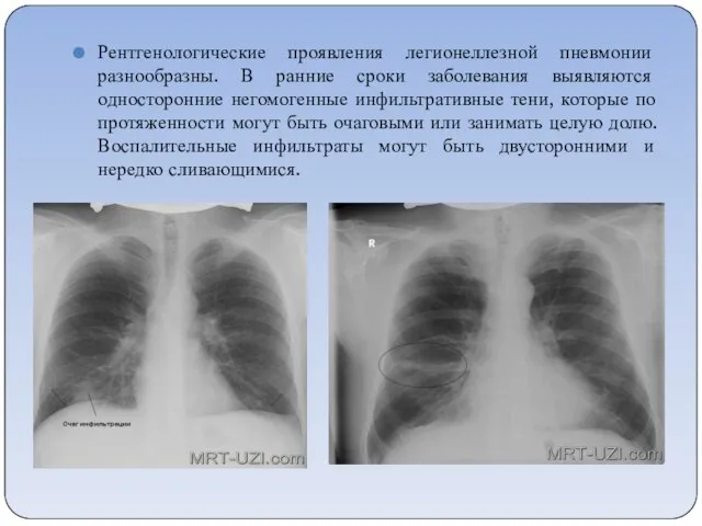 Рентгенологические проявления легионеллезной пневмонии разнообразны. В ранние сроки заболевания выявляются односторонние негомогенные