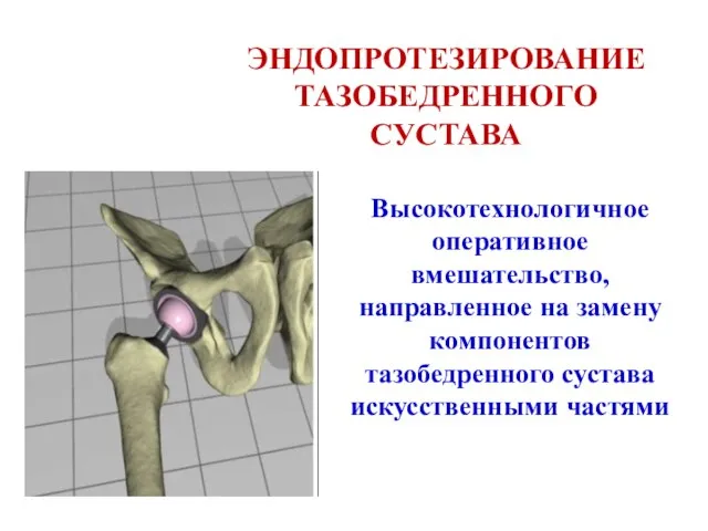 ЭНДОПРОТЕЗИРОВАНИЕ ТАЗОБЕДРЕННОГО СУСТАВА Высокотехнологичное оперативное вмешательство, направленное на замену компонентов тазобедренного сустава искусственными частями