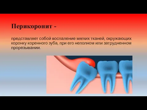 Перикоронит - представляет собой воспаление мягких тканей, окружающих коронку ко­ренного зуба, при