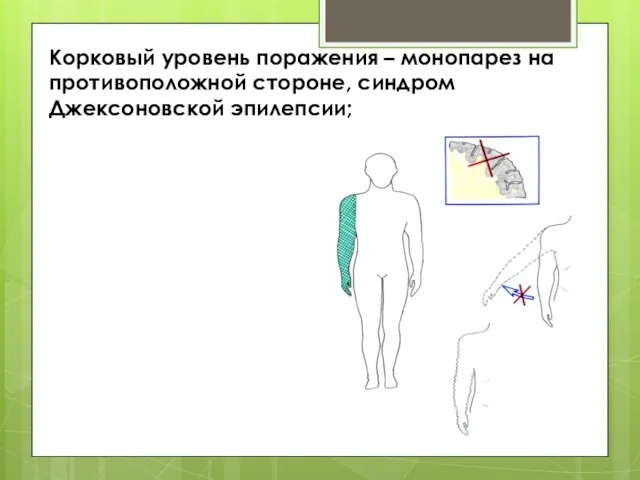 Корковый уровень поражения – монопарез на противоположной стороне, синдром Джексоновской эпилепсии;