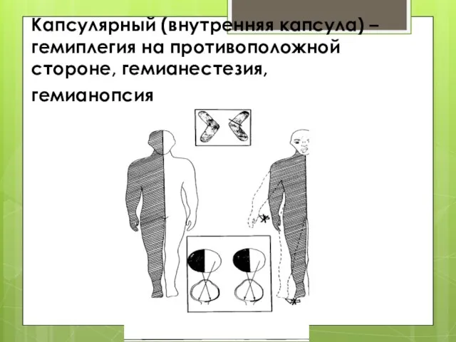 Капсулярный (внутренняя капсула) – гемиплегия на противоположной стороне, гемианестезия, гемианопсия