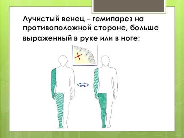 Лучистый венец – гемипарез на противоположной стороне, больше выраженный в руке или в ноге;