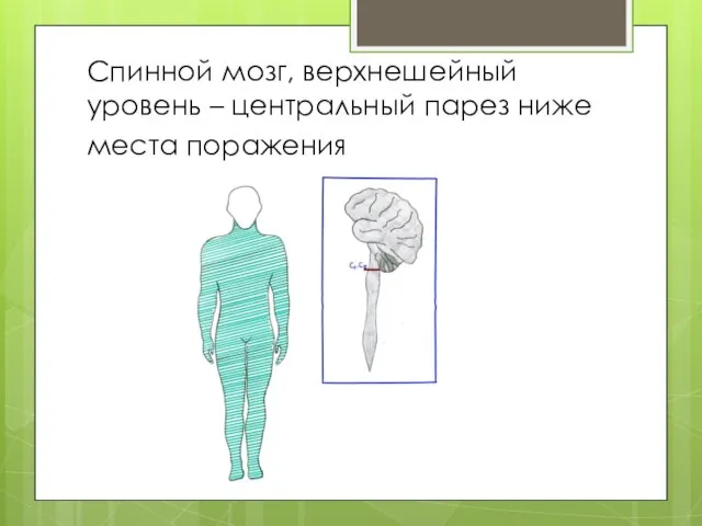 Спинной мозг, верхнешейный уровень – центральный парез ниже места поражения