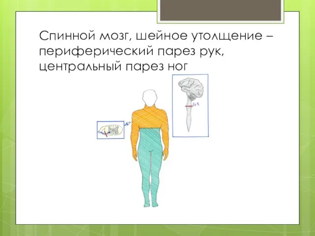 Спинной мозг, шейное утолщение – периферический парез рук, центральный парез ног