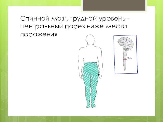 Спинной мозг, грудной уровень – центральный парез ниже места поражения