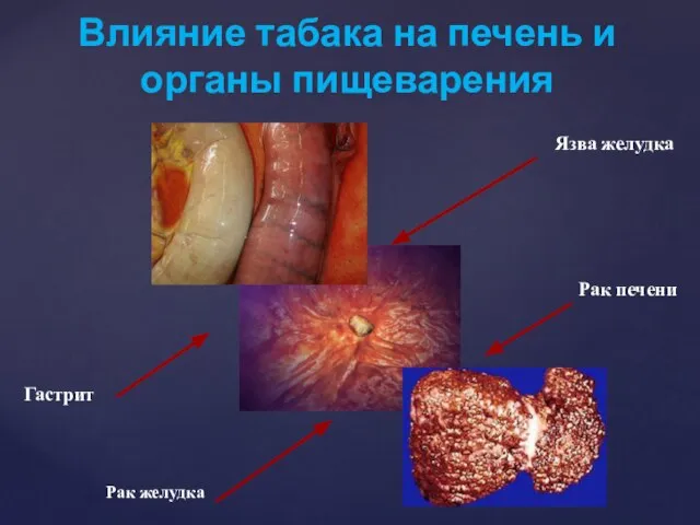 Влияние табака на печень и органы пищеварения Рак желудка Гастрит Рак печени Язва желудка
