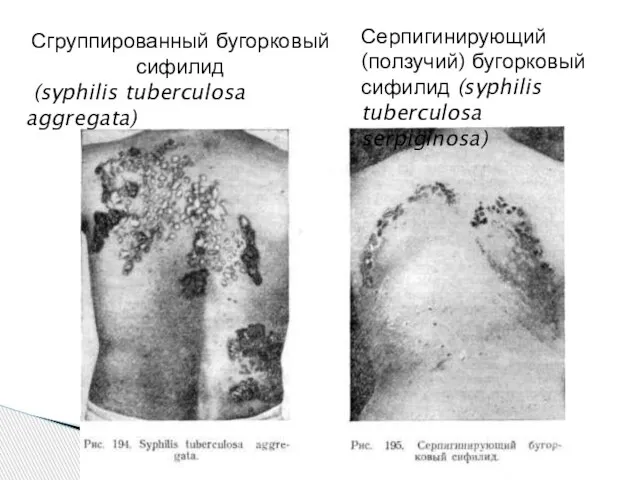 Сгруппированный бугорковый сифилид (syphilis tuberculosa aggregata) Серпигинирующий (ползучий) бугорковый сифилид (syphilis tuberculosa serpiginosa)