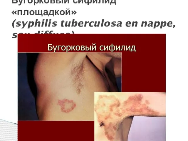 Бугорковый сифилид «площадкой» (syphilis tuberculosa en nappe, seu diffusa)