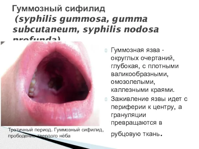 Гуммозная язва - округлых очертаний, глубокая, с плотными валикообразными, омозолелыми, каллезными краями.