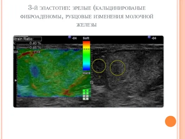 3-й эластотип: зрелые (кальцинированые фиброаденомы, рубцовые изменения молочной железы