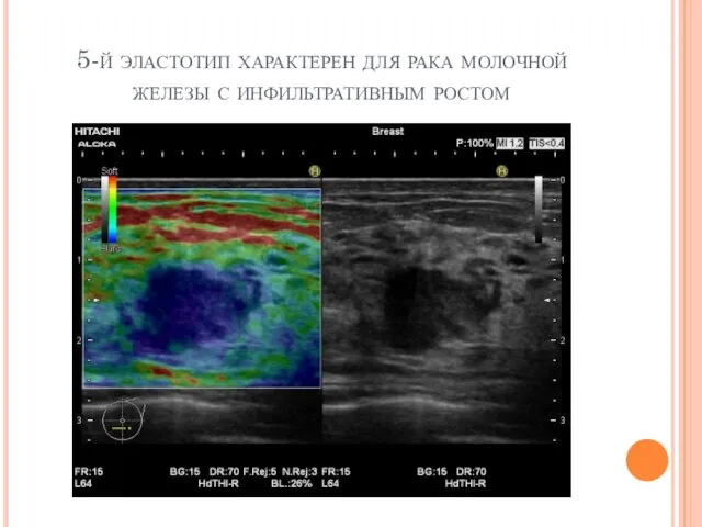 5-й эластотип характерен для рака молочной железы с инфильтративным ростом