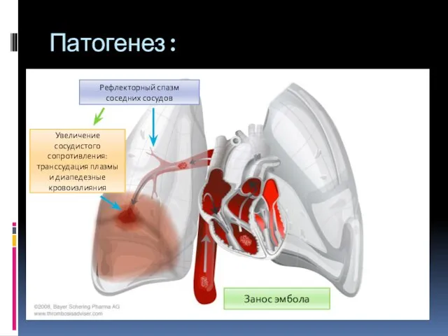 Патогенез: Занос эмбола Увеличение сосудистого сопротивления:транссудация плазмы и диапедезные кровоизлияния Рефлекторный спазм соседних сосудов