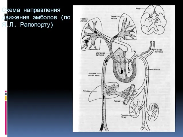 Схема направления движения эмболов (по Я.Л. Рапопорту)