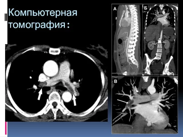 Компьютерная томография: