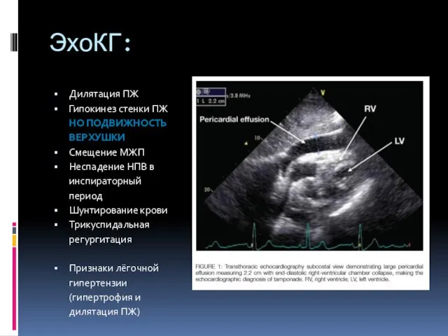 ЭхоКГ: Дилятация ПЖ Гипокинез стенки ПЖ НО ПОДВИЖНОСТЬ ВЕРХУШКИ Смещение МЖП Неспадение