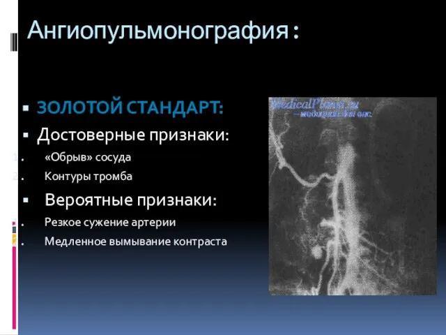 Ангиопульмонография: ЗОЛОТОЙ СТАНДАРТ: Достоверные признаки: «Обрыв» сосуда Контуры тромба Вероятные признаки: Резкое