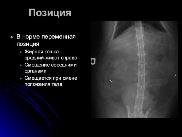 Позиция В норме переменная позиция Жирная кошка –средний-живот справо Смещение соседними органами