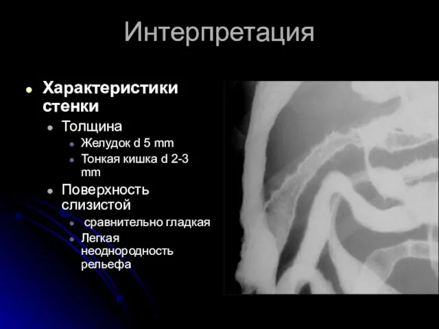 Интерпретация Характеристики стенки Толщина Желудок d 5 mm Тонкая кишка d 2-3