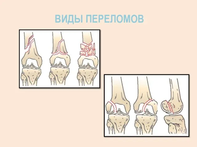 ВИДЫ ПЕРЕЛОМОВ