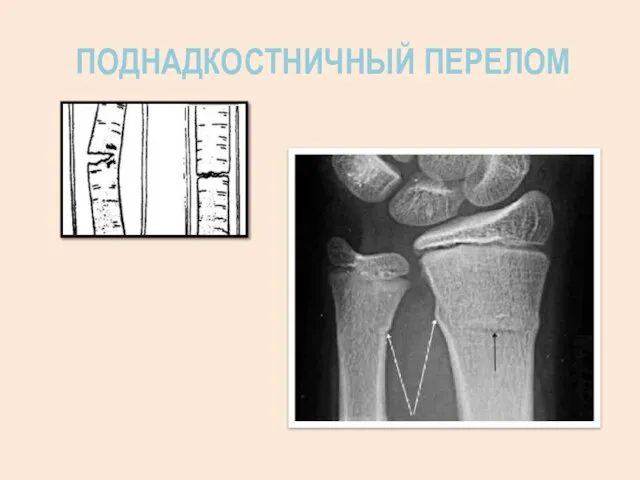 ПОДНАДКОСТНИЧНЫЙ ПЕРЕЛОМ