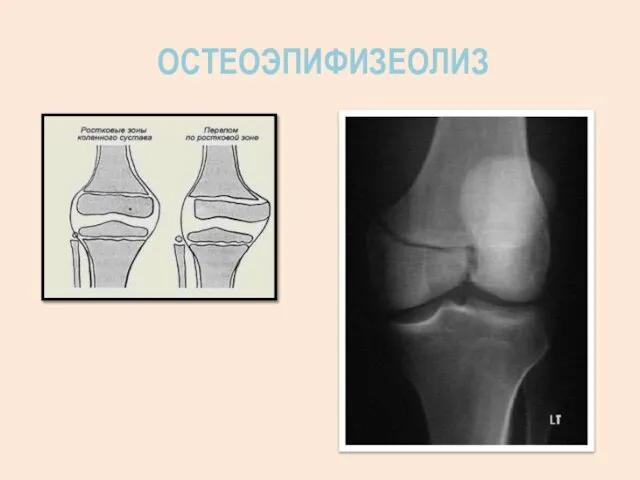 ОСТЕОЭПИФИЗЕОЛИЗ