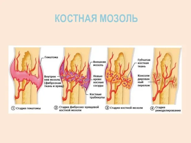 КОСТНАЯ МОЗОЛЬ