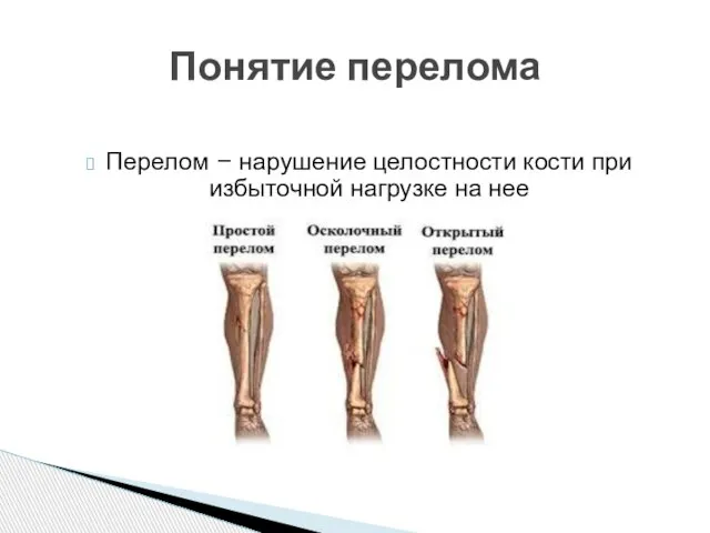 Перелом – нарушение целостности кости при избыточной нагрузке на нее Понятие перелома