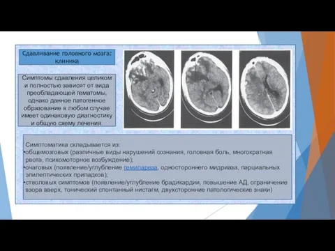 Сдавливание головного мозга: клиника Симптоматика складывается из: общемозговых (различные виды нарушений сознания,