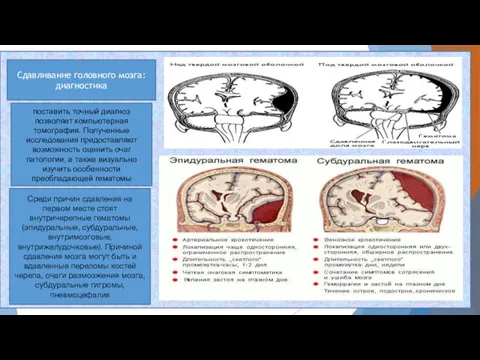 Сдавливание головного мозга: диагностика поставить точный диагноз позволяет компьютерная томография. Полученные исследования