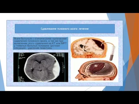 Сдавливание головного мозга: лечение Всем больным с клиническими признаками сдавления головного мозга,