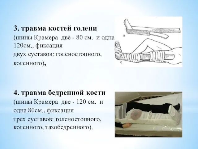 3. травма костей голени (шины Крамера две - 80 см. и одна