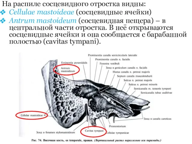 На распиле сосцевидного отростка видны: Cellulae mastoideae (сосцевидные ячейки) Antrum mastoideum (сосцевидная