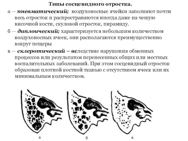 Типы сосцевидного отростка. а — пневматический; воздухоносные ячейки заполняют почти весь отросток