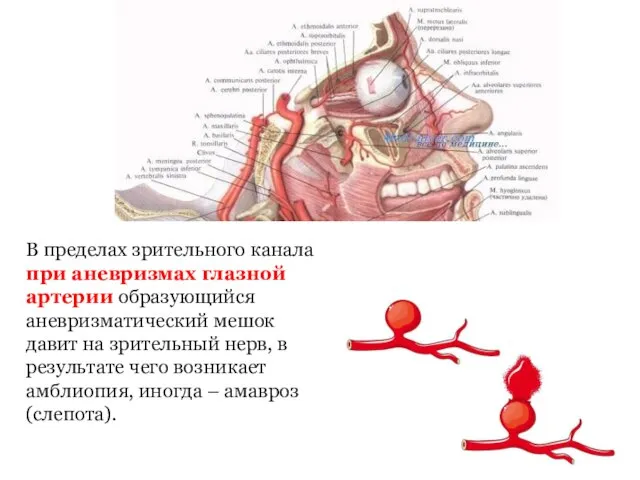 В пределах зрительного канала при аневризмах глазной артерии образующийся аневризматический мешок давит