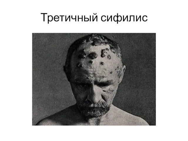 Третичный сифилис