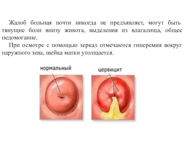 Жалоб больная почти никогда не предъявляет, могут быть тянущие боли внизу живота,