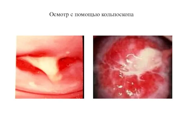 Осмотр с помощью кольпоскопа