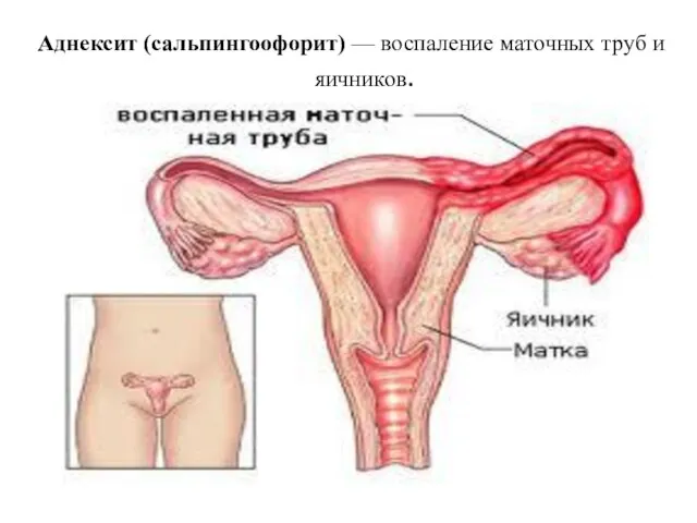 Аднексит (сальпингоофорит) — воспаление маточных труб и яичников.