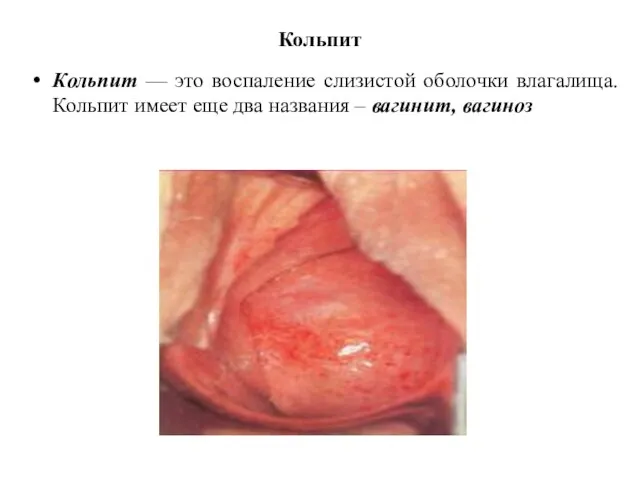 Кольпит Кольпит — это воспаление слизистой оболочки влагалища. Кольпит имеет еще два названия – вагинит, вагиноз