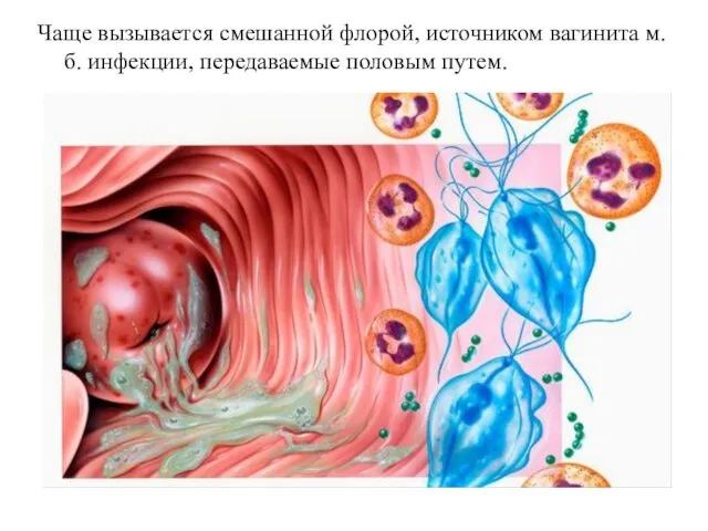 Чаще вызывается смешанной флорой, источником вагинита м.б. инфекции, передаваемые половым путем.