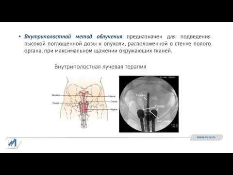 Внутриполостной метод облучения предназначен для подведения высокой поглощенной дозы к опухоли, расположенной