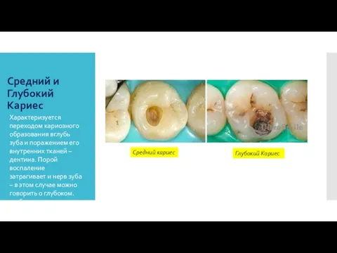 Средний и Глубокий Кариес Характеризуется переходом кариозного образования вглубь зуба и поражением