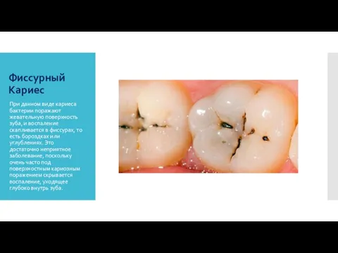 Фиссурный Кариес При данном виде кариеса бактерии поражают жевательную поверхность зуба, и