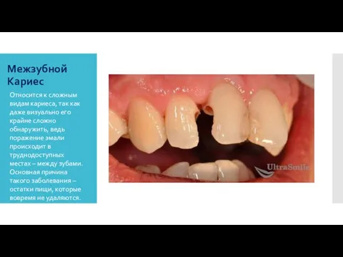 Межзубной Кариес Относится к сложным видам кариеса, так как даже визуально его