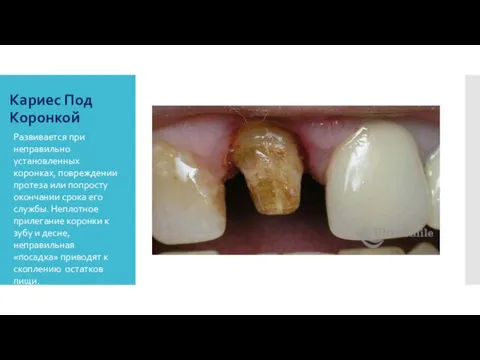 Кариес Под Коронкой Развивается при неправильно установленных коронках, повреждении протеза или попросту