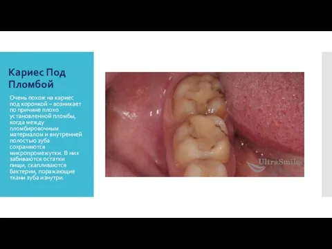 Кариес Под Пломбой Очень похож на кариес под коронкой – возникает по