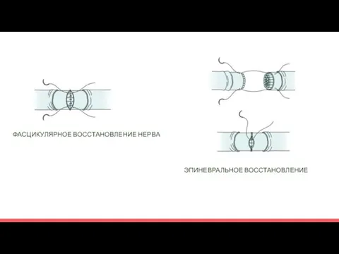 ЭПИНЕВРАЛЬНОЕ ВОССТАНОВЛЕНИЕ ФАСЦИКУЛЯРНОЕ ВОССТАНОВЛЕНИЕ НЕРВА