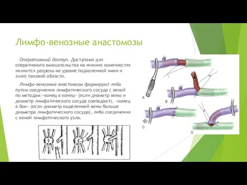 Лимфо-венозные анастомозы Оперативный доступ. Доступами для оперативного вмешательства на нижних конечностях являются