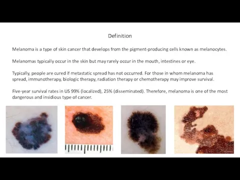 Definition Melanoma is a type of skin cancer that develops from the